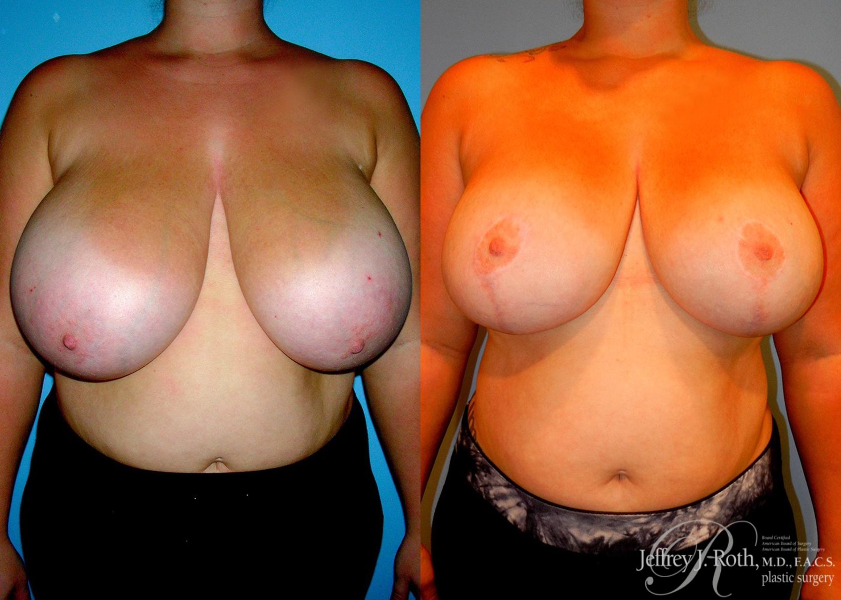 Before & After Breast Reduction Case 85 View #1 View in Las Vegas, NV