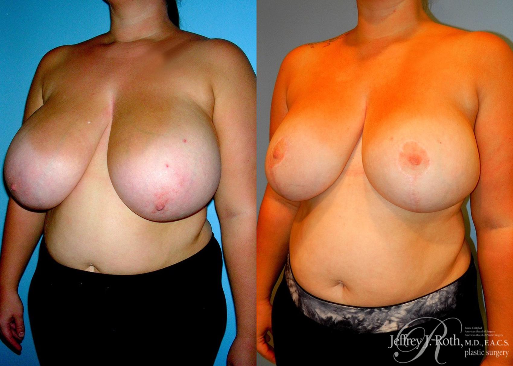 Before & After Breast Reduction Case 85 View #2 View in Las Vegas, NV