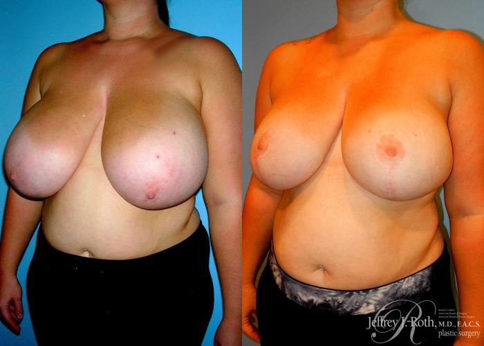 Before & After Breast Reduction Case 85 View #2 View in Las Vegas and Henderson, NV