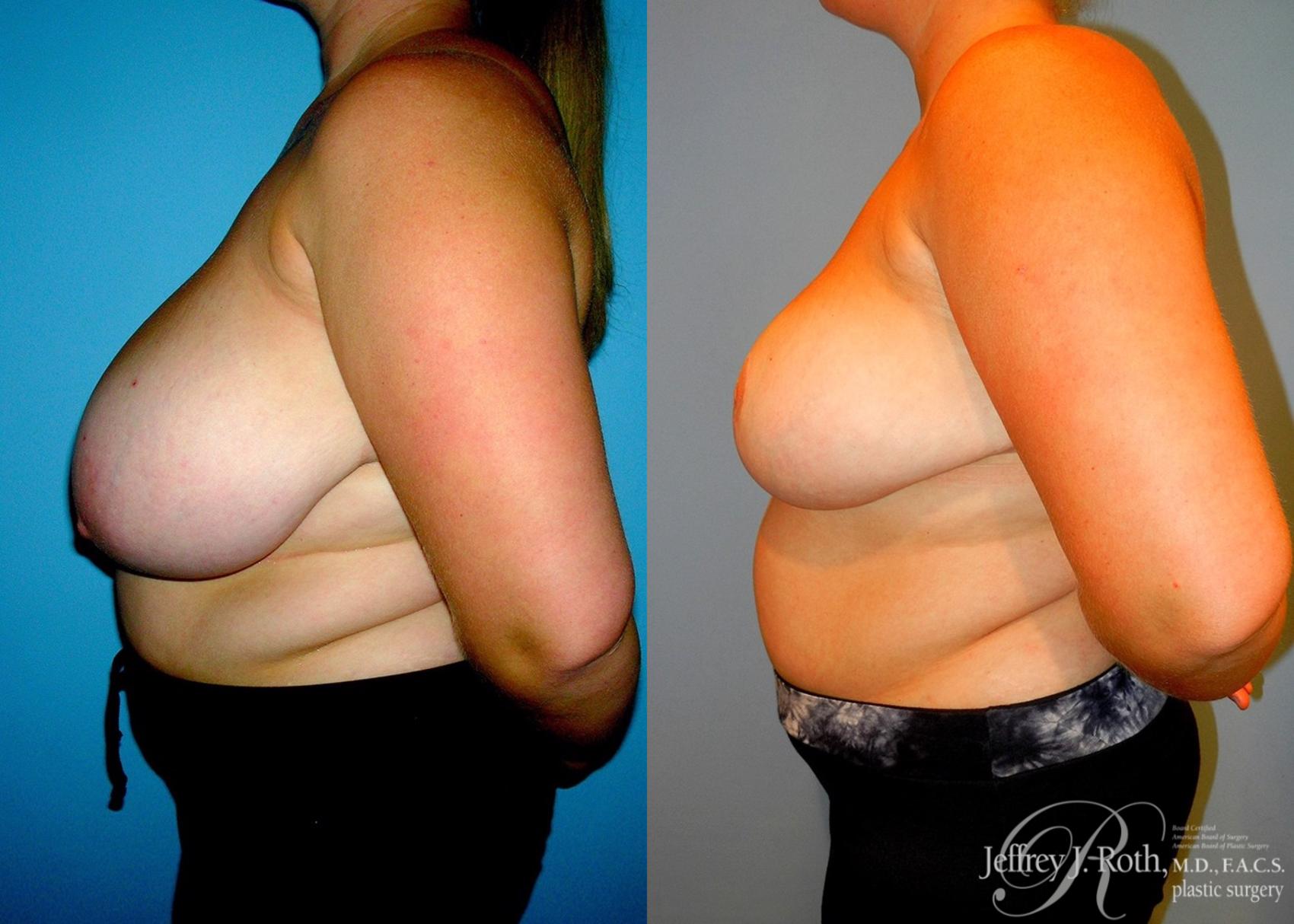 Before & After Breast Reduction Case 85 View #3 View in Las Vegas, NV
