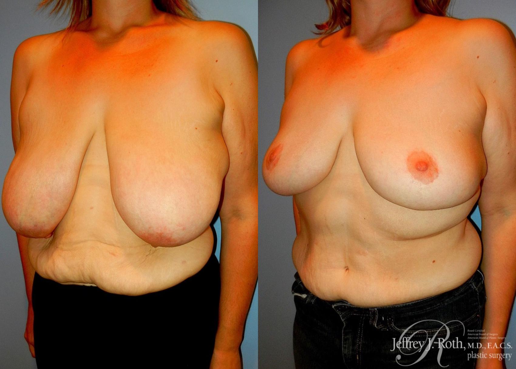 Before & After Breast Reduction Case 86 View #2 View in Las Vegas, NV