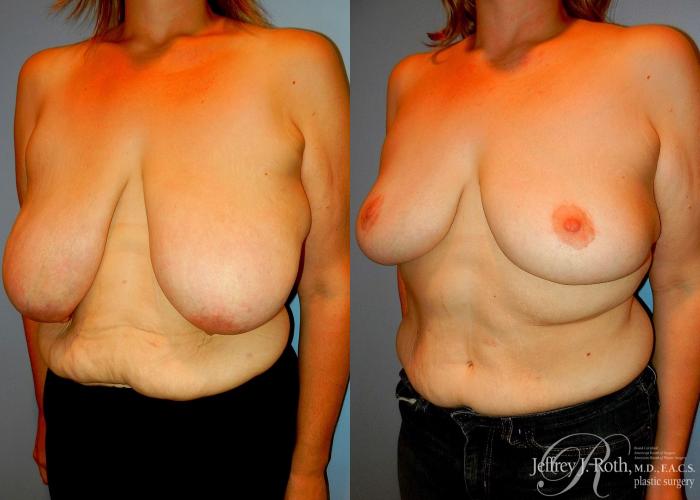 Before & After Breast Reduction Case 86 View #2 View in Las Vegas and Henderson, NV