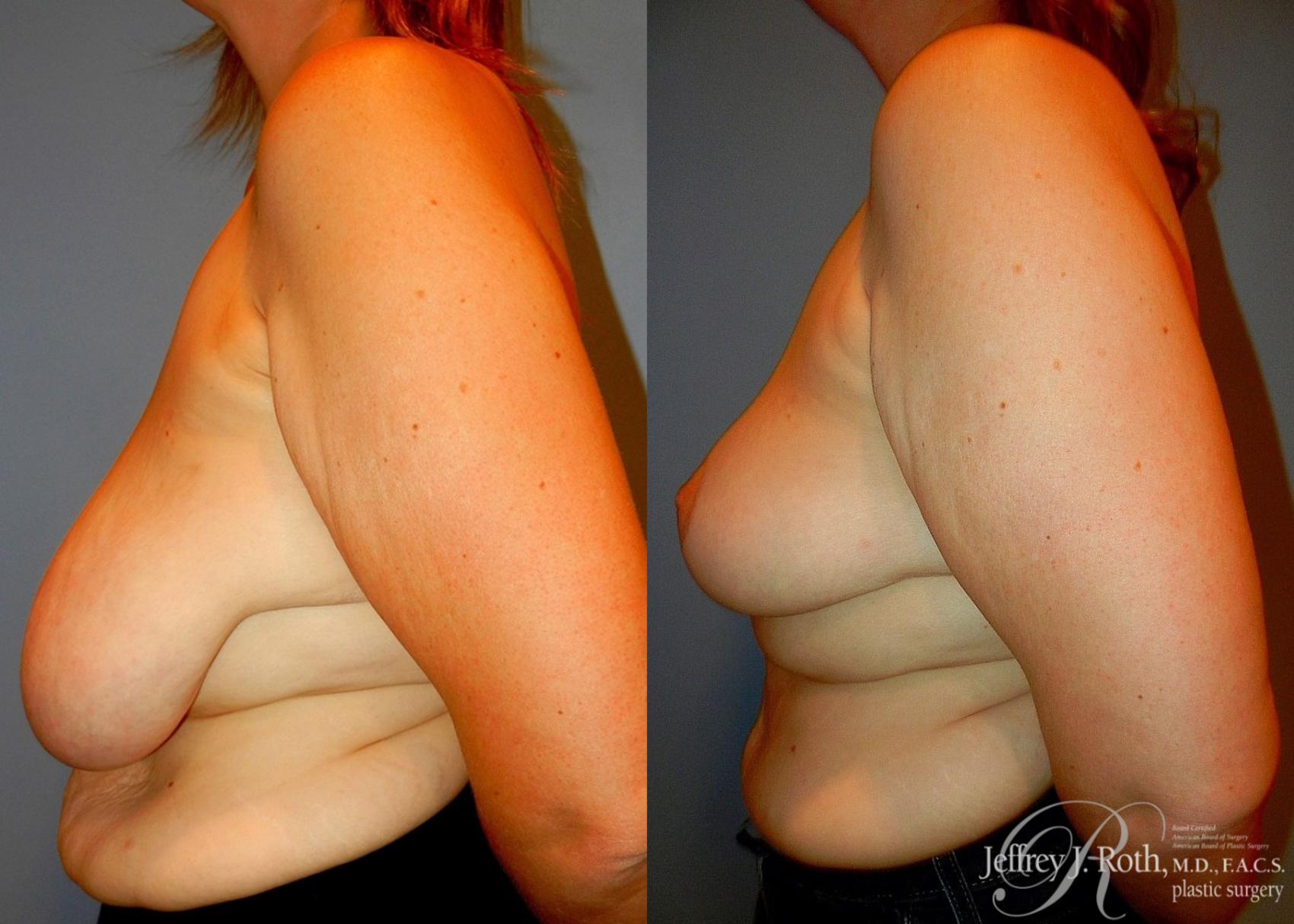 Before & After Breast Reduction Case 86 View #3 View in Las Vegas, NV