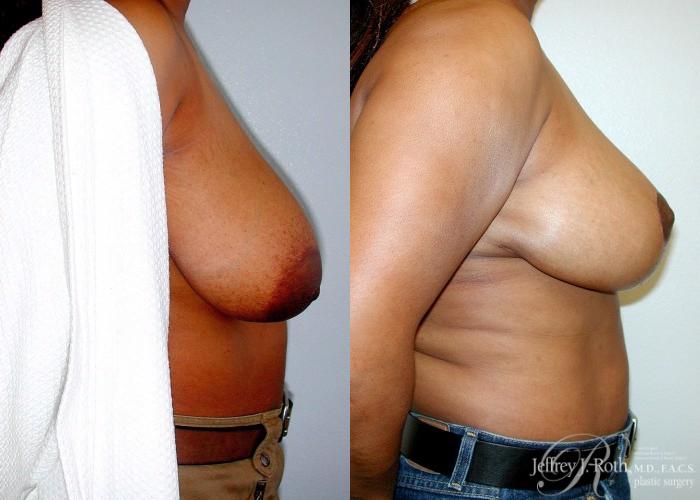 Before & After Breast Reduction Case 87 View #3 View in Las Vegas, NV