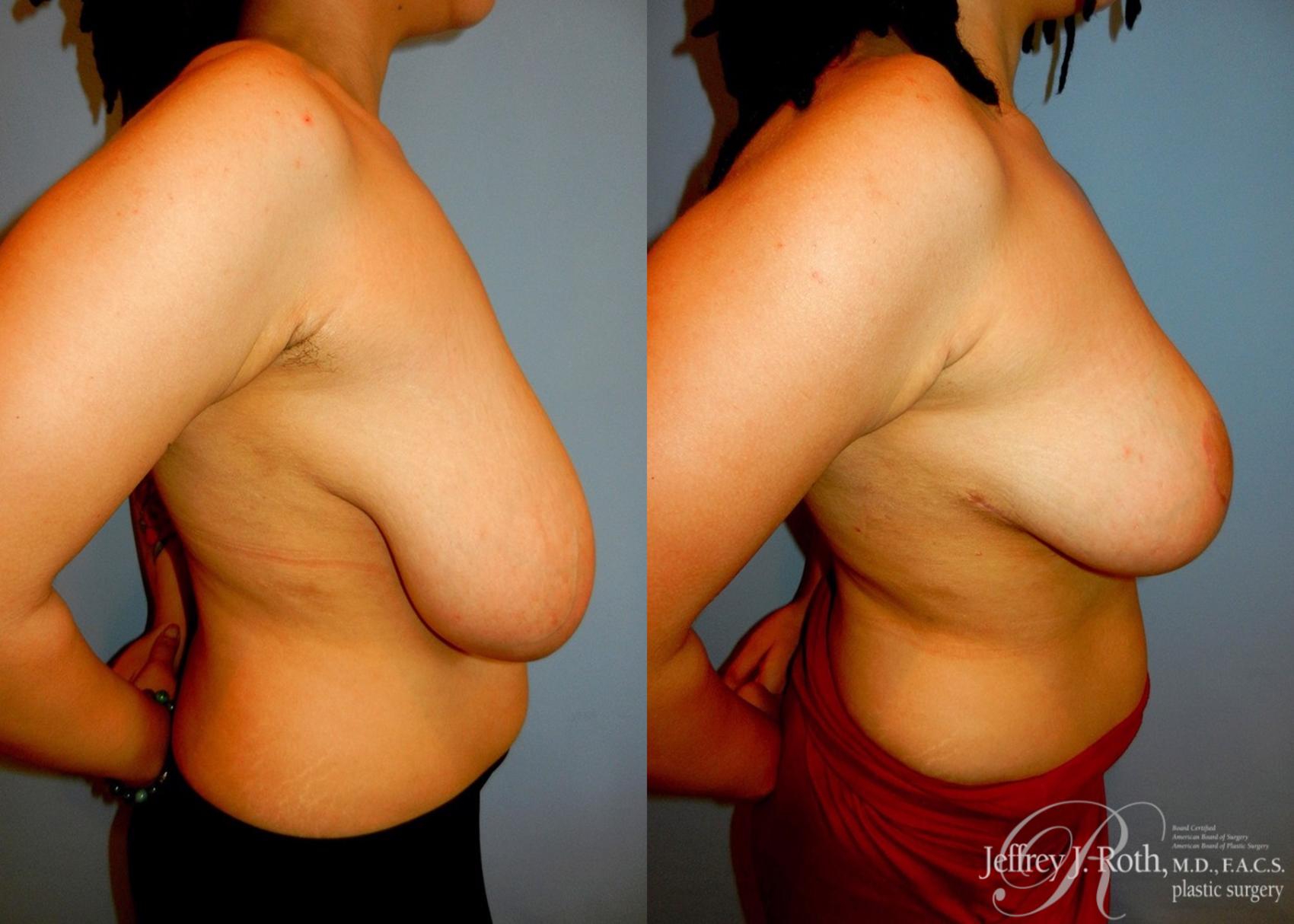 Before & After Breast Reduction Case 88 View #3 View in Las Vegas, NV