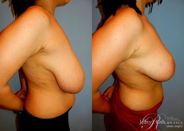 Before & After Breast Reduction Case 88 View #3 View in Las Vegas and Henderson, NV