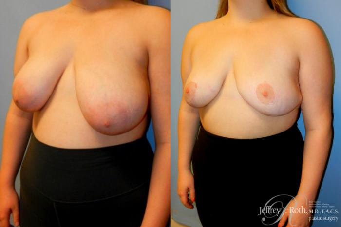 Before & After Breast Reduction Case 89 View #2 View in Las Vegas and Henderson, NV