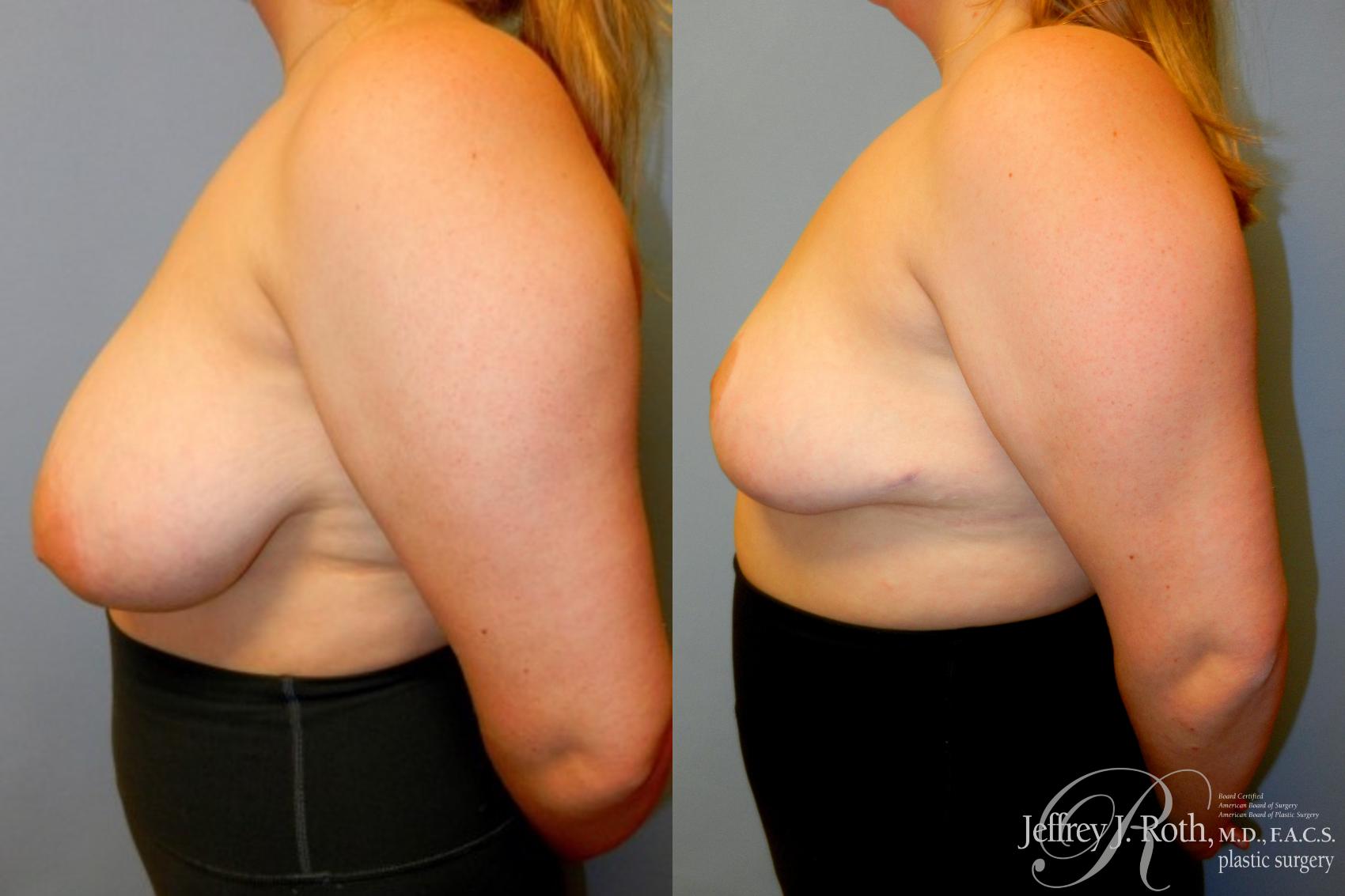 Before & After Breast Reduction Case 89 View #3 View in Las Vegas, NV