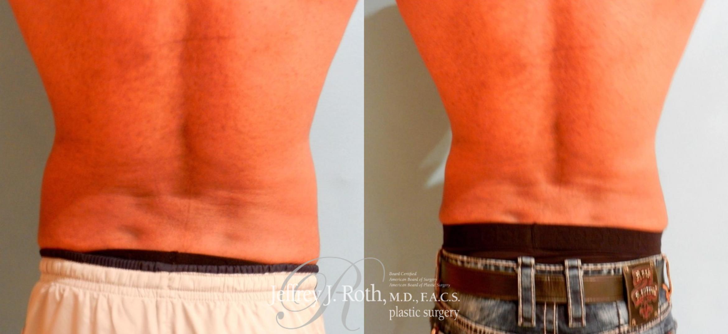 Before & After CoolSculpting® for Men Case 165 View #1 View in Las Vegas, NV