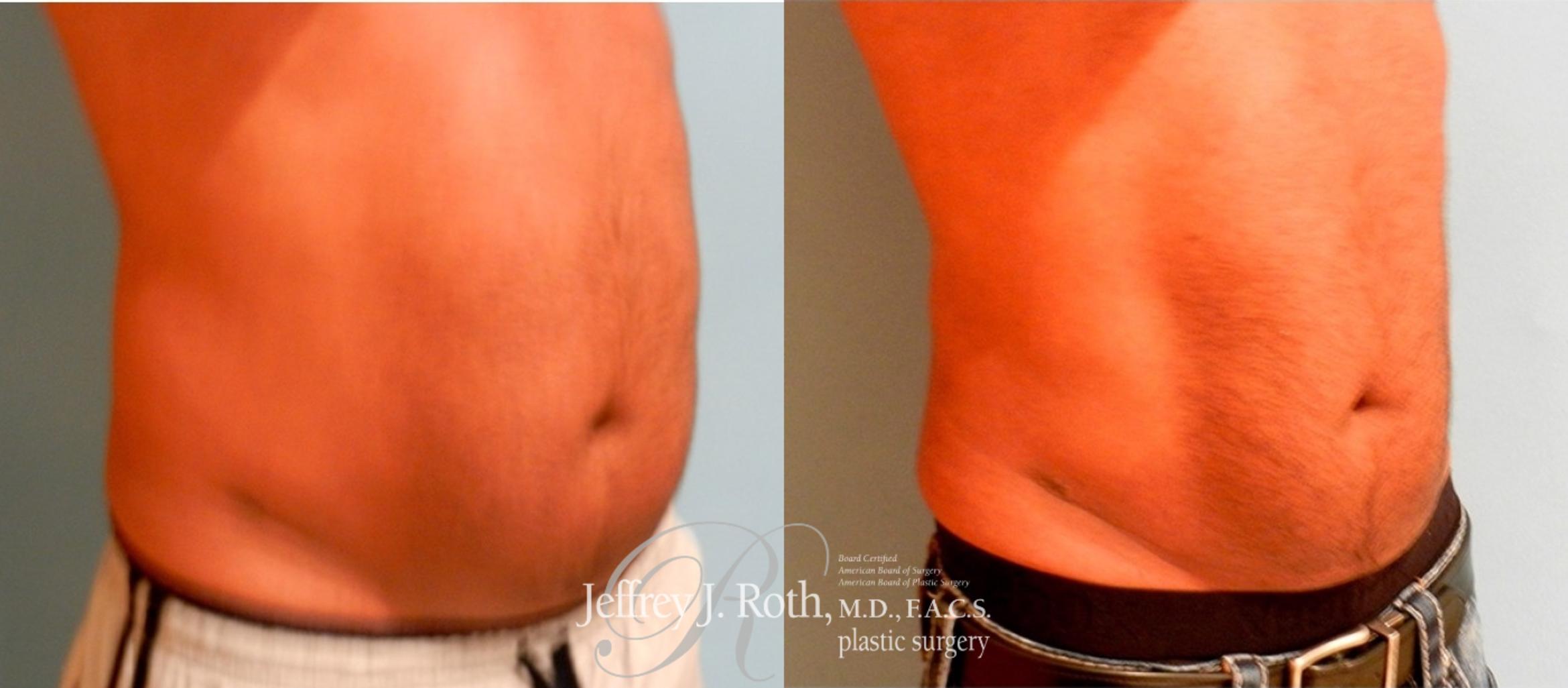 Before & After CoolSculpting® for Men Case 165 View #2 View in Las Vegas, NV