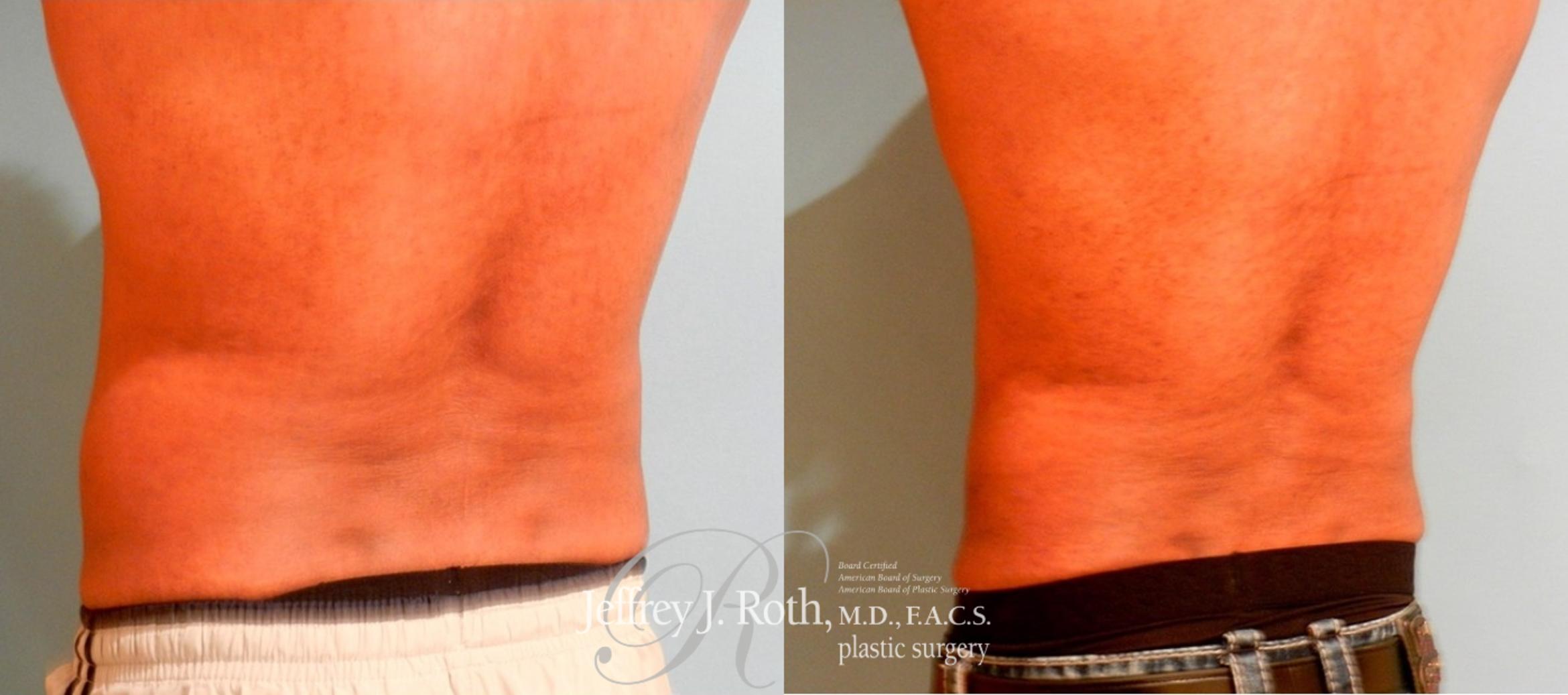 Before & After CoolSculpting® Case 165 View #3 View in Las Vegas, NV