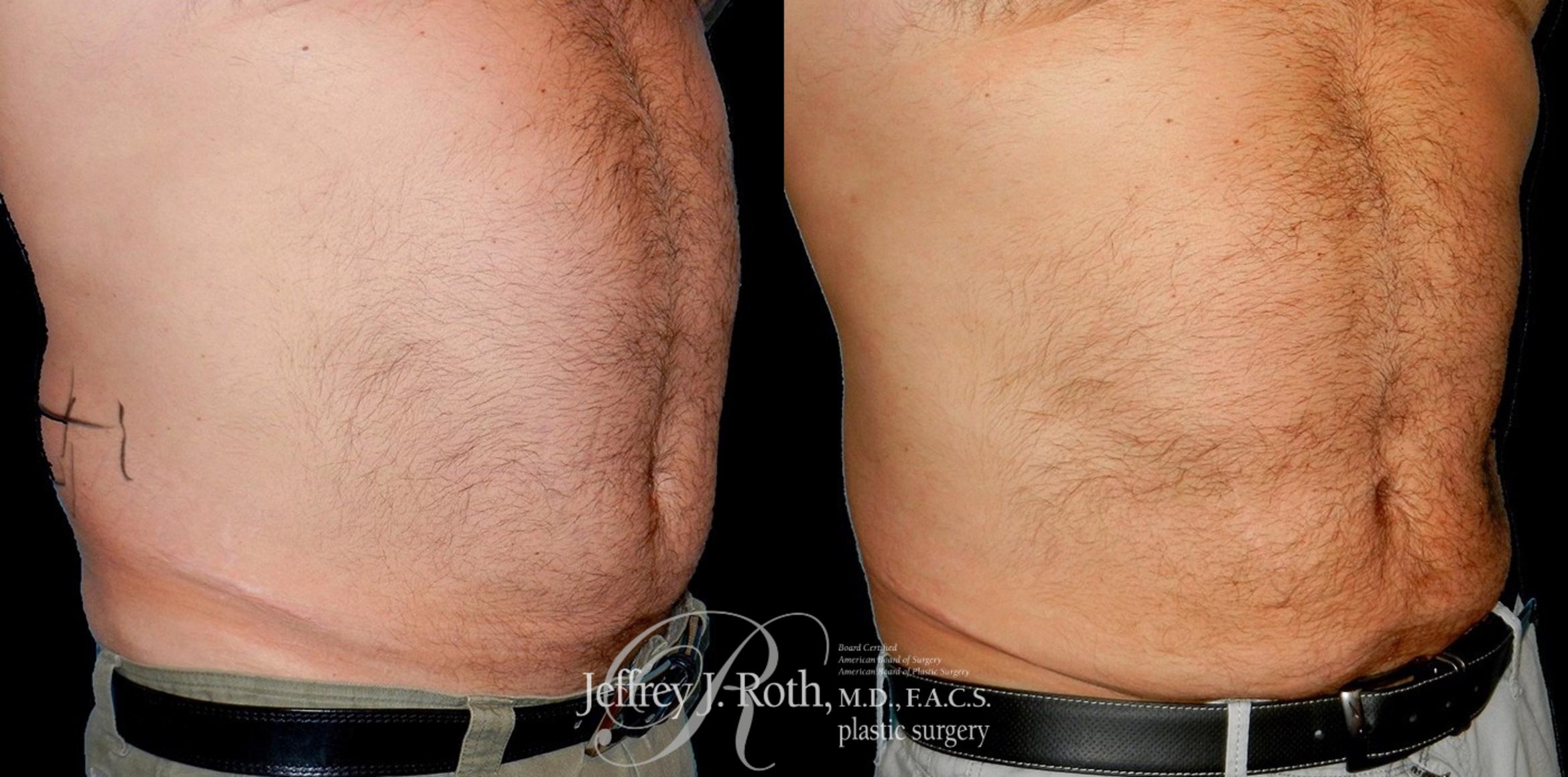Before & After CoolSculpting® Case 166 View #1 View in Las Vegas, NV