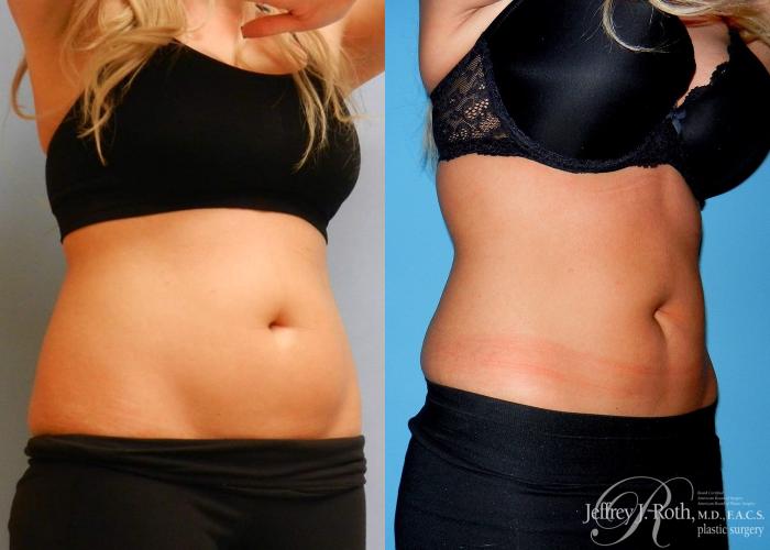 Before & After CoolSculpting® Case 3 View #2 View in Las Vegas, NV