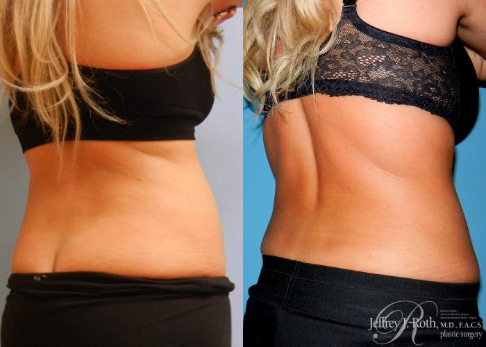 Before & After CoolSculpting® Case 3 View #3 View in Las Vegas, NV