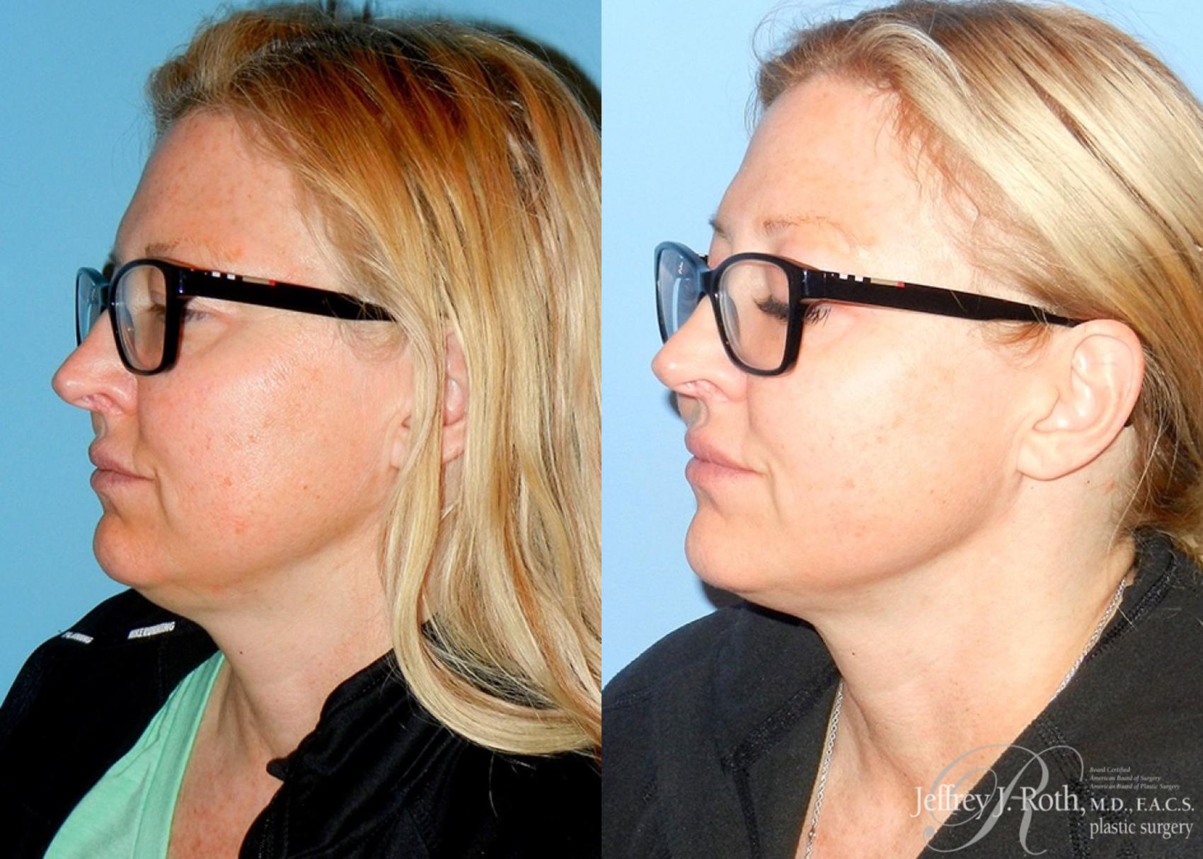 Before & After CoolSculpting® Case 4 View #2 View in Las Vegas, NV