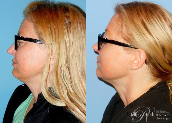 Before & After CoolSculpting® Case 4 View #3 View in Las Vegas, NV