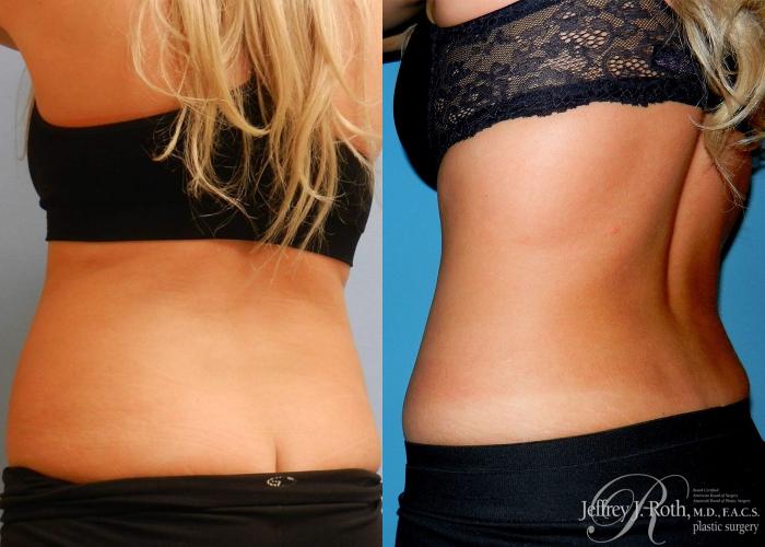 Before & After CoolSculpting® Case 5 View #3 View in Las Vegas, NV