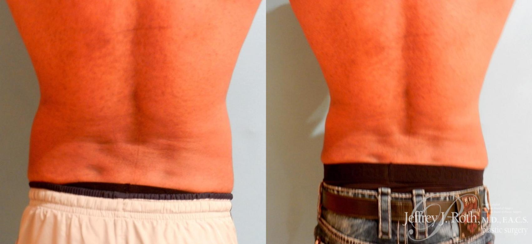 Before & After CoolSculpting® Case 165 View #1 View in Las Vegas, NV