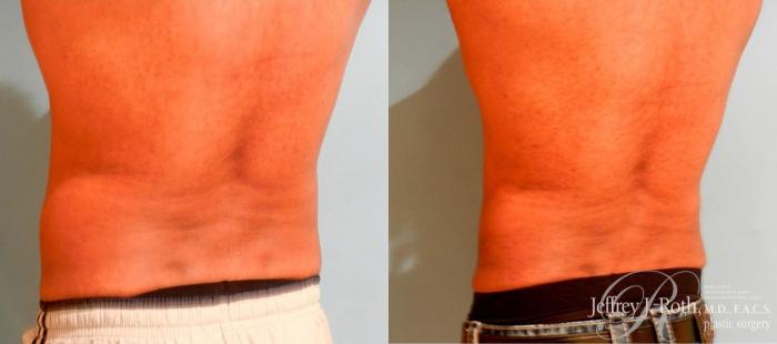 Before & After CoolSculpting® for Men Case 165 View #3 View in Las Vegas, NV