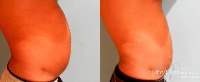 Before & After CoolSculpting® for Men Case 165 View #4 View in Las Vegas, NV