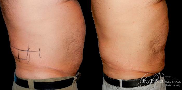Before & After CoolSculpting® for Men Case 166 View #3 View in Las Vegas, NV