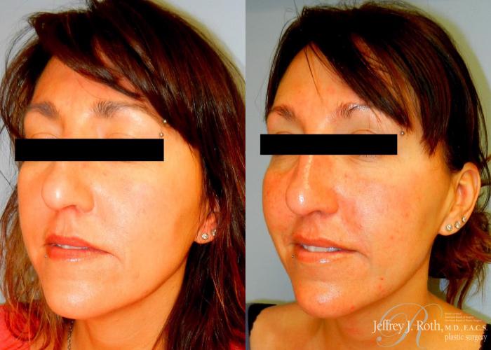Before & After Dermal Fillers Case 146 View #2 View in Las Vegas and Henderson, NV