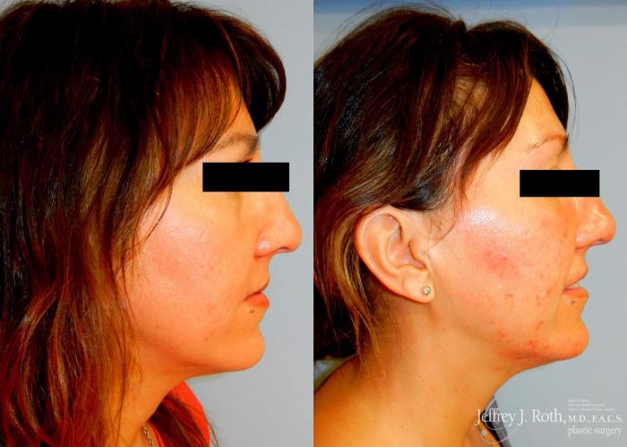 Before & After Dermal Fillers Case 146 View #3 View in Las Vegas and Henderson, NV