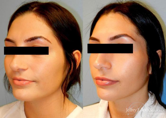 Before & After Dermal Fillers Case 147 View #2 View in Las Vegas and Henderson, NV