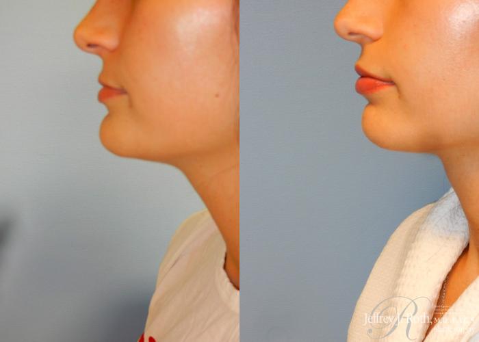 Before & After Dermal Fillers Case 147 View #3 View in Las Vegas and Henderson, NV