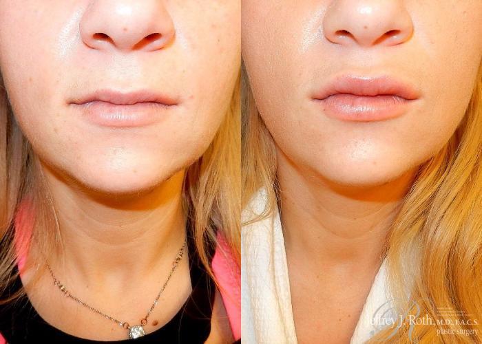 Before & After Dermal Fillers Case 148 View #1 View in Las Vegas and Henderson, NV