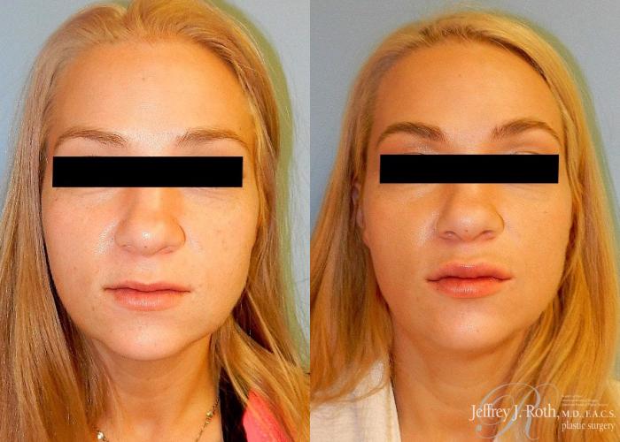 Before & After Dermal Fillers Case 148 View #2 View in Las Vegas and Henderson, NV