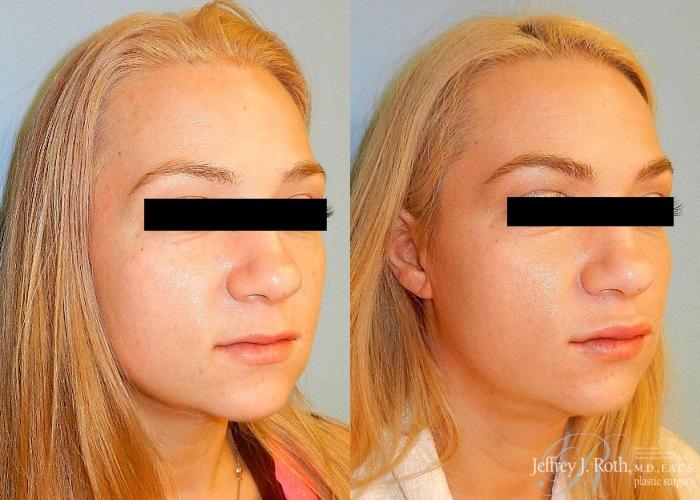 Before & After Dermal Fillers Case 148 View #3 View in Las Vegas and Henderson, NV