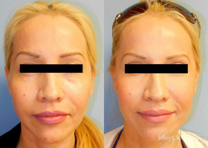Before & After Dermal Fillers Case 149 View #1 View in Las Vegas and Henderson, NV
