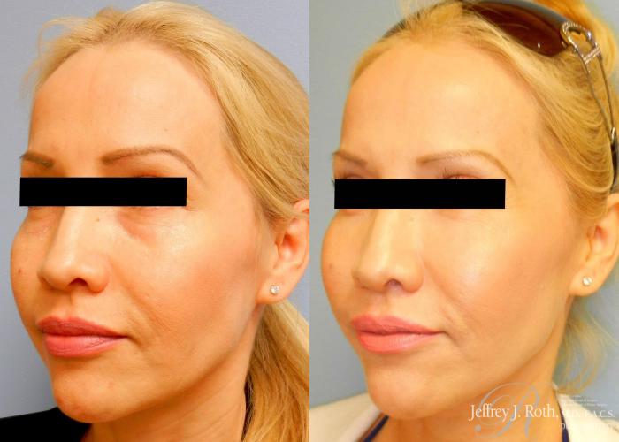 Before & After Dermal Fillers Case 149 View #2 View in Las Vegas and Henderson, NV
