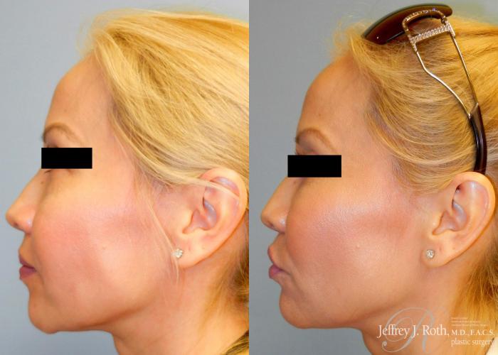 Before & After Dermal Fillers Case 149 View #3 View in Las Vegas and Henderson, NV