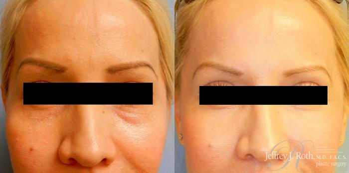 Before & After Dermal Fillers Case 149 View #4 View in Las Vegas and Henderson, NV