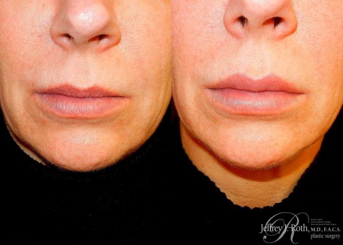 Before & After Dermal Fillers Case 150 View #1 View in Las Vegas and Henderson, NV