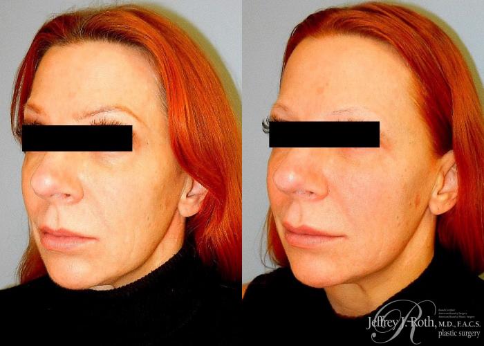 Before & After Dermal Fillers Case 150 View #2 View in Las Vegas and Henderson, NV