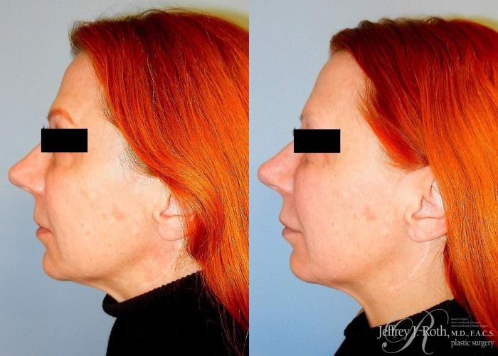 Before & After Dermal Fillers Case 150 View #3 View in Las Vegas and Henderson, NV
