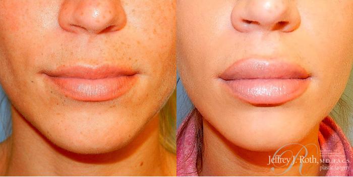 Before & After Dermal Fillers Case 151 View #1 View in Las Vegas and Henderson, NV