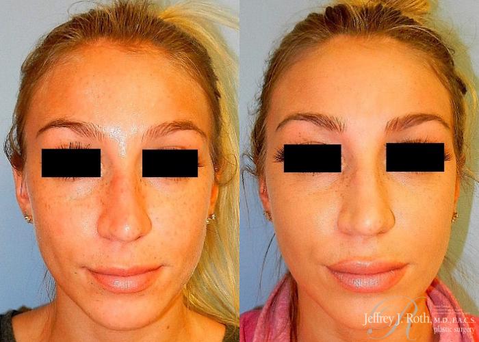Before & After Dermal Fillers Case 151 View #2 View in Las Vegas and Henderson, NV