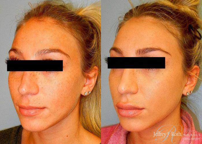 Before & After Dermal Fillers Case 151 View #3 View in Las Vegas and Henderson, NV