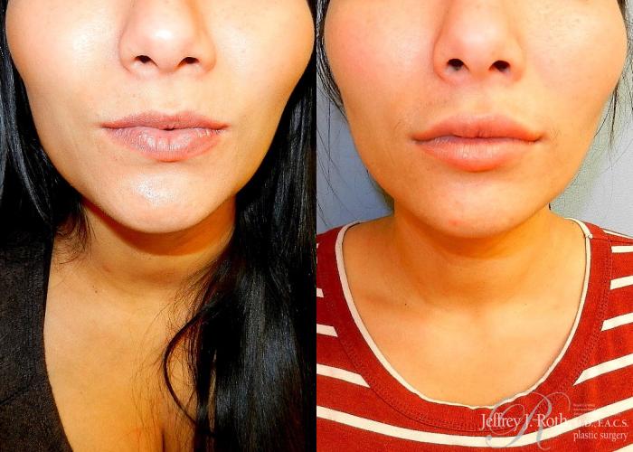 Before & After Dermal Fillers Case 152 View #1 View in Las Vegas and Henderson, NV