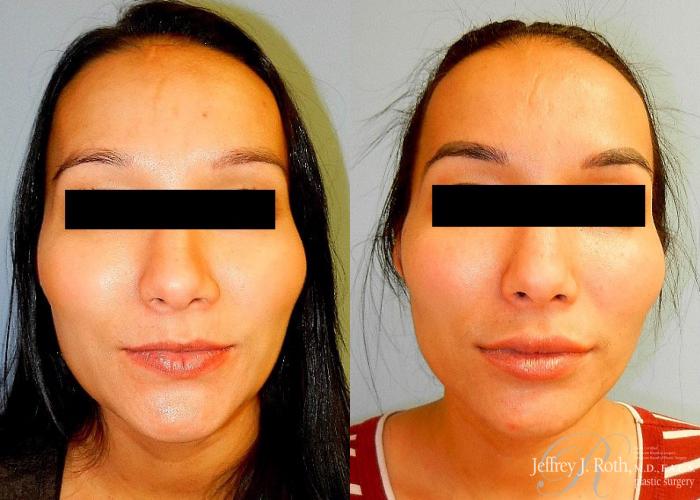 Before & After Dermal Fillers Case 152 View #2 View in Las Vegas and Henderson, NV