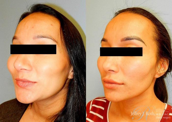 Before & After Dermal Fillers Case 152 View #3 View in Las Vegas and Henderson, NV