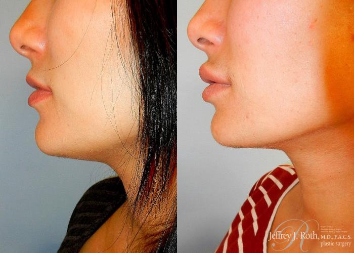 Before & After Dermal Fillers Case 152 View #4 View in Las Vegas and Henderson, NV