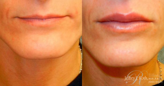 Before & After Dermal Fillers Case 153 View #1 View in Las Vegas and Henderson, NV