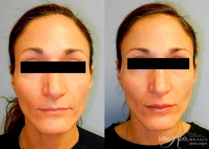 Before & After Dermal Fillers Case 153 View #2 View in Las Vegas and Henderson, NV