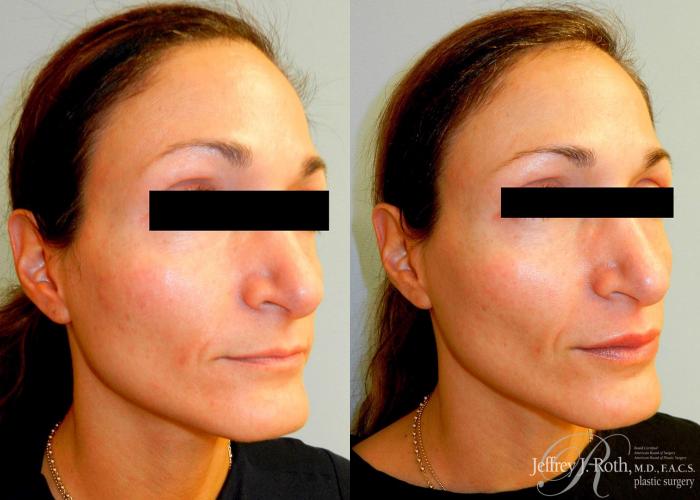 Before & After Dermal Fillers Case 153 View #3 View in Las Vegas and Henderson, NV