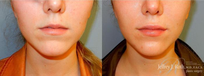 Before & After Dermal Fillers Case 154 View #1 View in Las Vegas and Henderson, NV